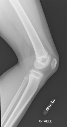 Acute on Chronic A-vault-ion Injury