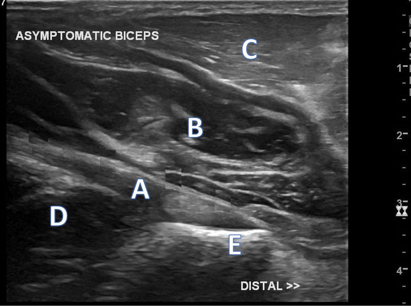 Anterior Elbow