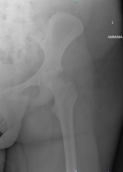 Not So Typical Hip Dislocation