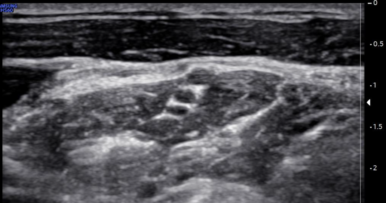 Regional Anesthesia Interscalene Block