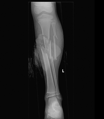 Splinting Series Part 1: Indication and Application