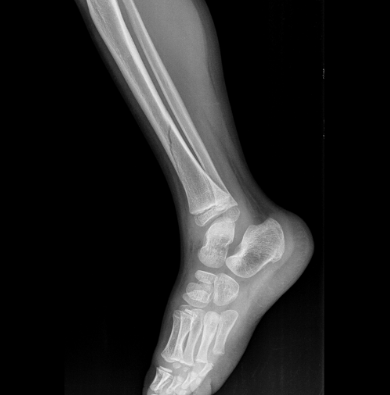 Splinting Series Part 2: Lower Extremity