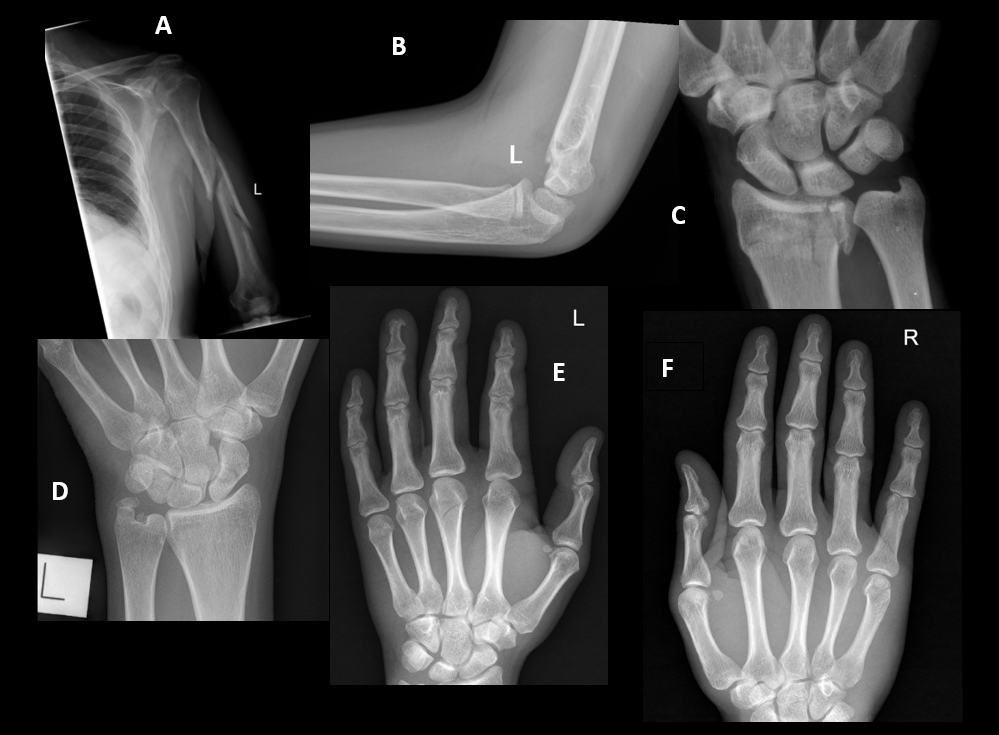 Splinting Series, Part 3: Upper Extremity